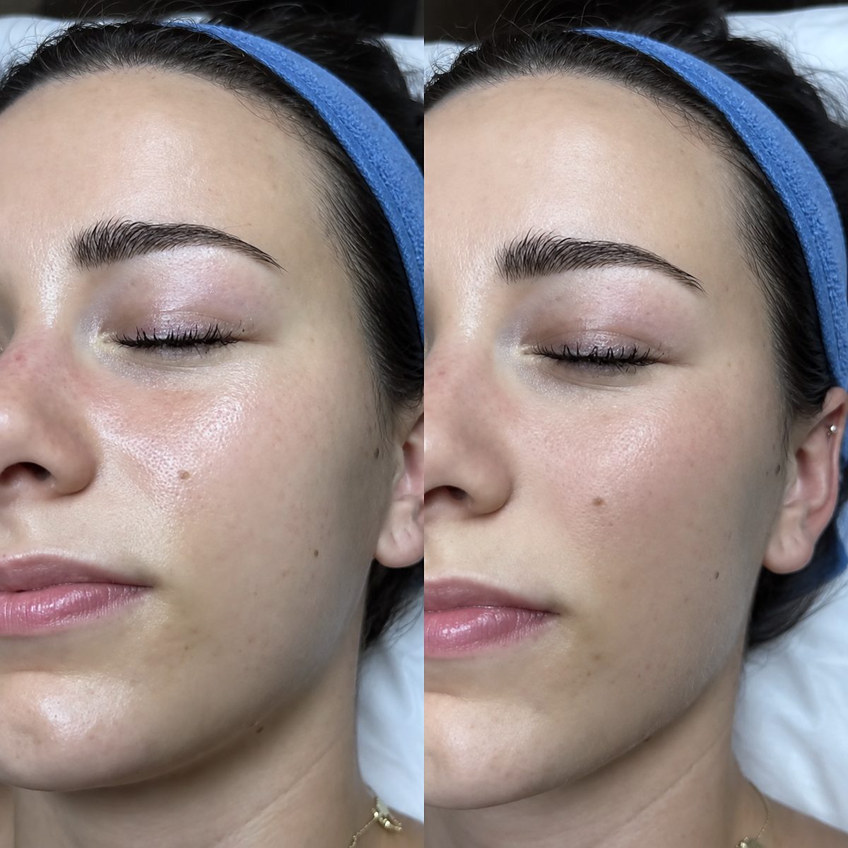 Online kurz dermaplaning